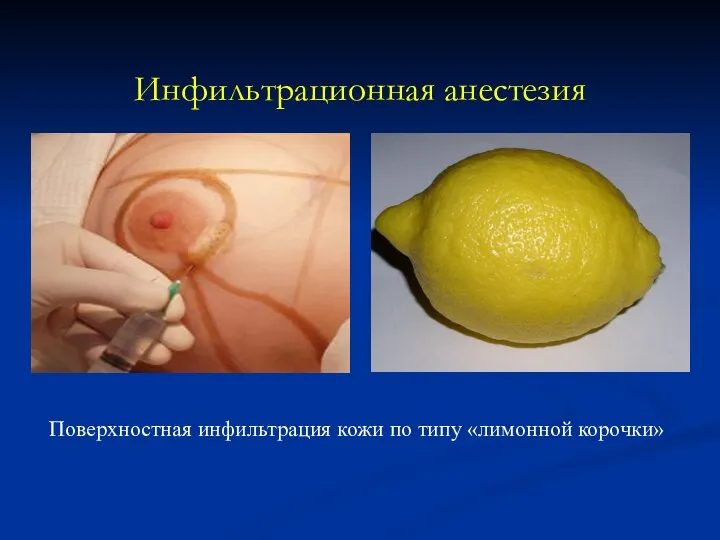 Инфильтрационная анестезия Поверхностная инфильтрация кожи по типу «лимонной корочки»