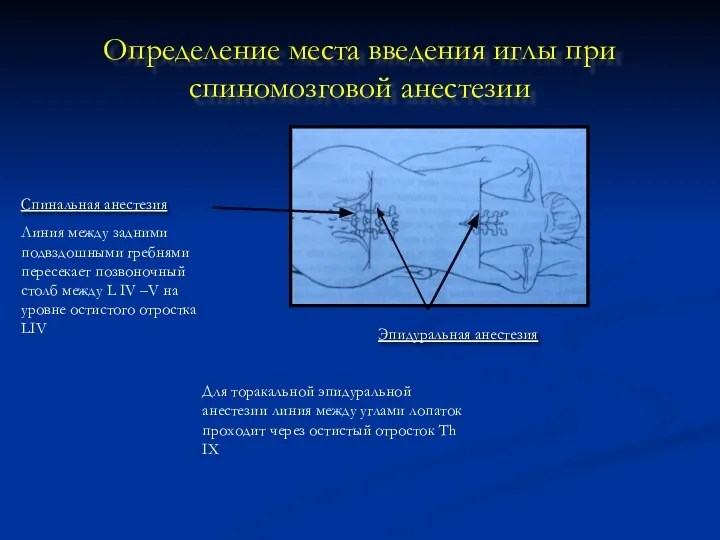 Определение места введения иглы при спиномозговой анестезии Эпидуральная анестезия Спинальная анестезия