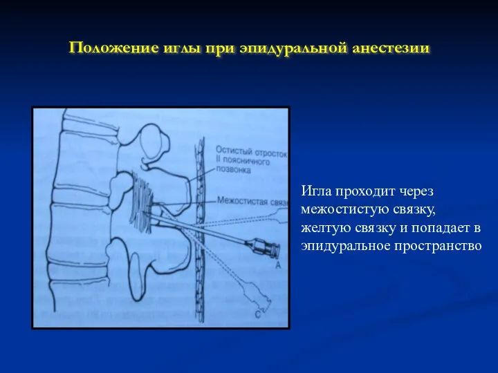Положение иглы при эпидуральной анестезии Игла проходит через межостистую связку, желтую