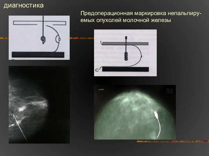 Предоперационная маркировка непальпиру- емых опухолей молочной железы диагностика