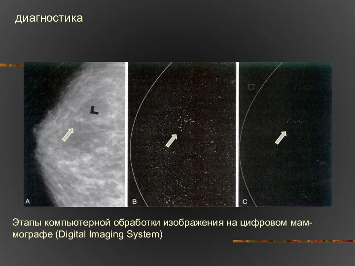 Этапы компьютерной обработки изображения на цифровом мам- мографе (Digital Imaging System) диагностика