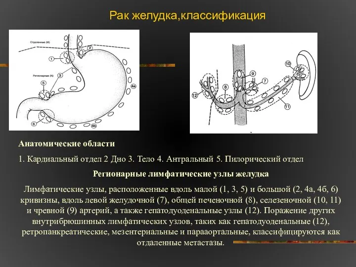 Рак желудка,классификация Анатомические области 1. Кардиальный отдел 2 Дно 3. Тело