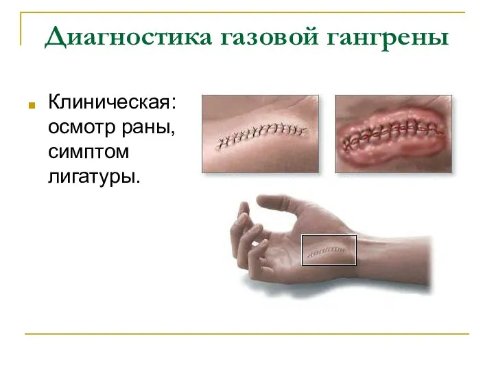 Диагностика газовой гангрены Клиническая: осмотр раны, симптом лигатуры.