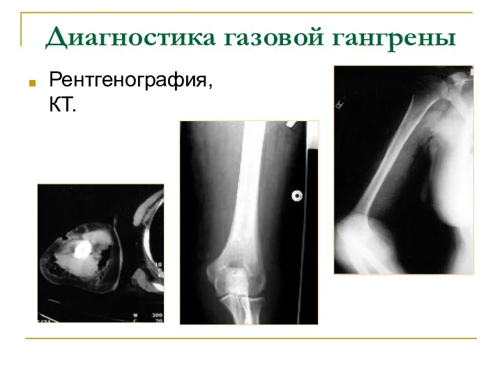 Диагностика газовой гангрены Рентгенография, КТ.