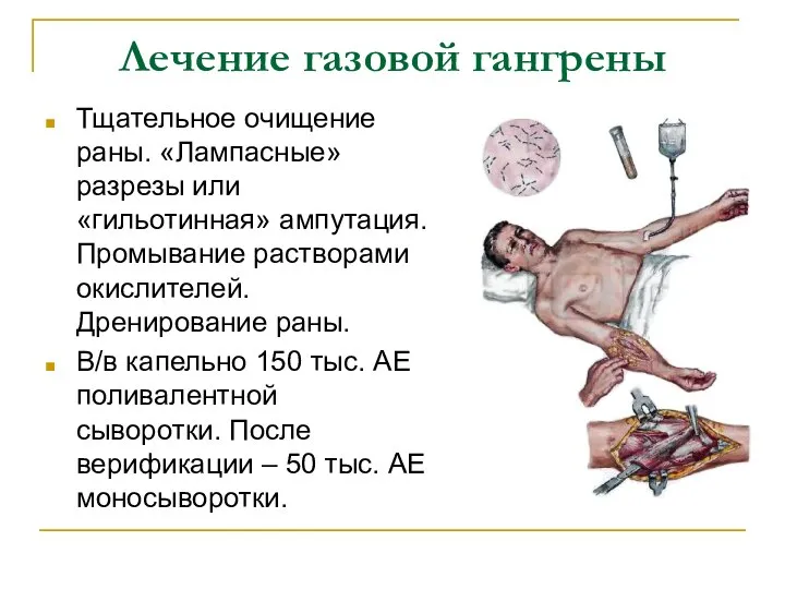 Лечение газовой гангрены Тщательное очищение раны. «Лампасные» разрезы или «гильотинная» ампутация.