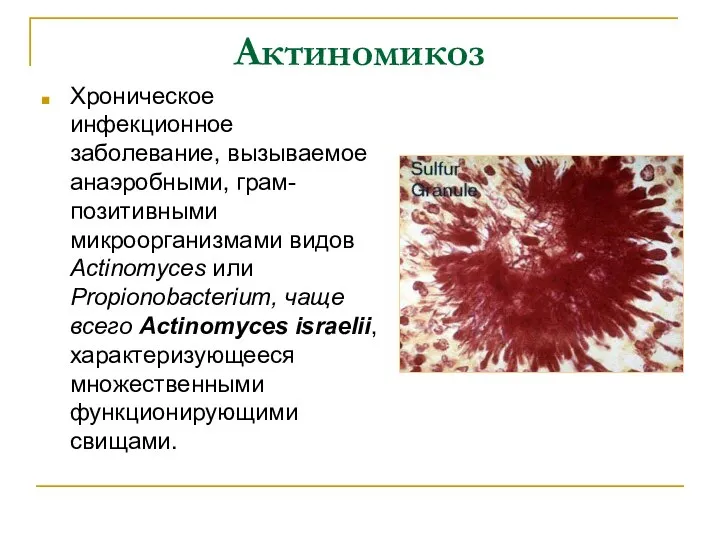 Актиномикоз Хроническое инфекционное заболевание, вызываемое анаэробными, грам-позитивными микроорганизмами видов Actinomyces или