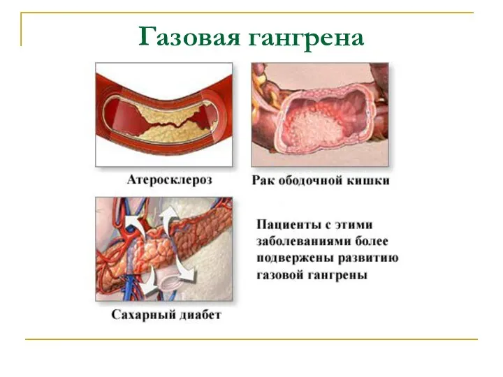 Газовая гангрена