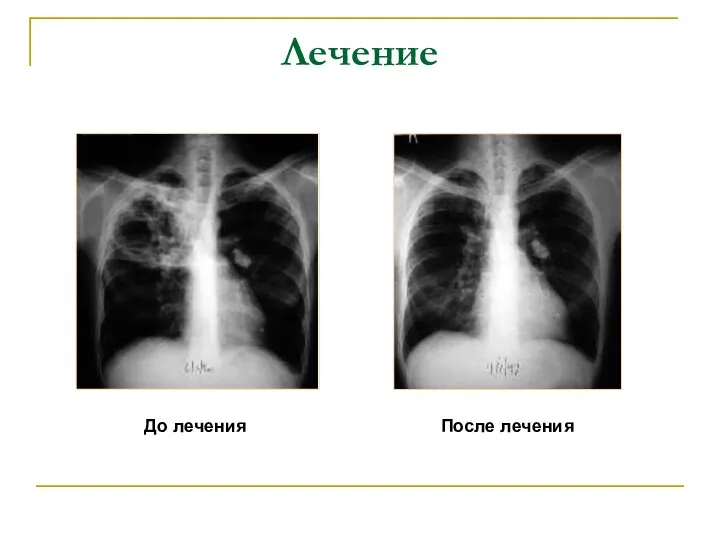 Лечение До лечения После лечения