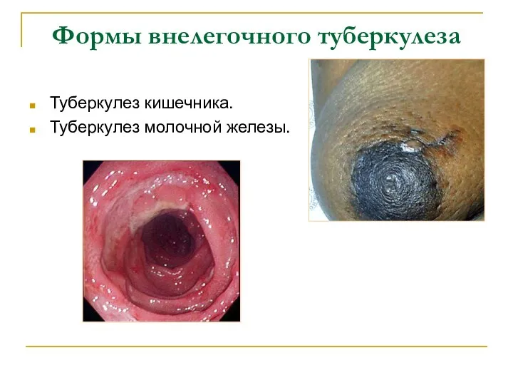 Формы внелегочного туберкулеза Туберкулез кишечника. Туберкулез молочной железы.