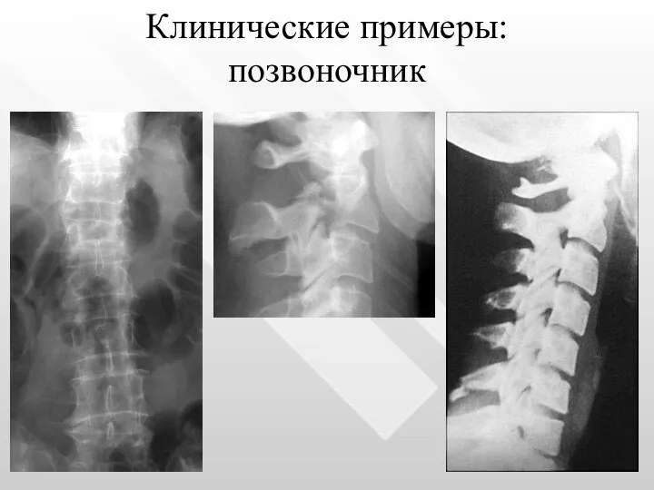 Клинические примеры: позвоночник