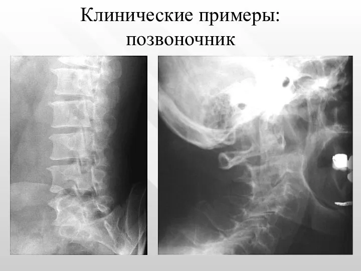 Клинические примеры: позвоночник