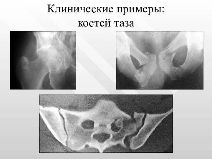 Клинические примеры: костей таза