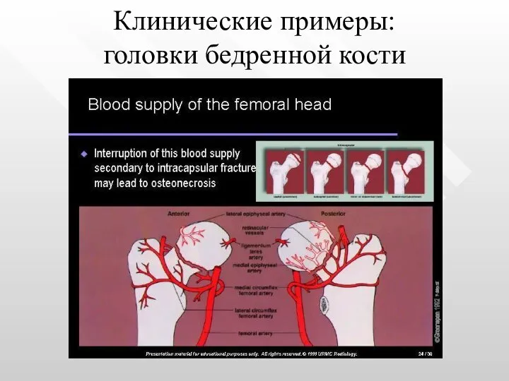 Клинические примеры: головки бедренной кости