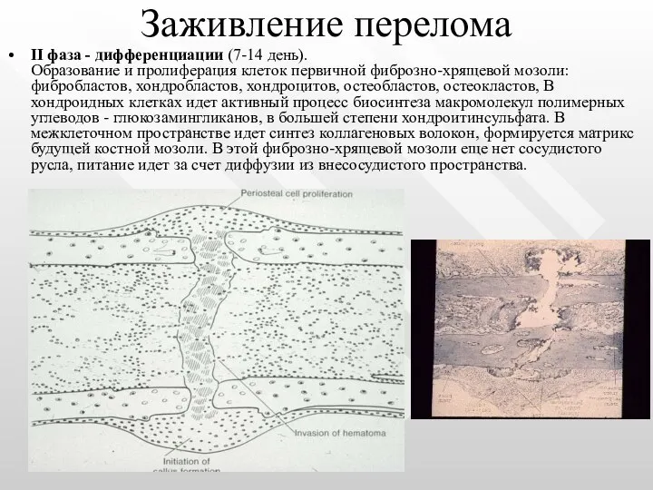 Заживление перелома II фаза - дифференциации (7-14 день). Образование и пролиферация