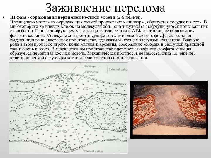 Заживление перелома III фаза - образования первичной костной мозоли (2-6 неделя).