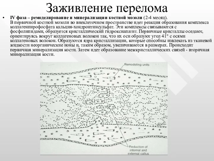 Заживление перелома IV фаза – ремоделирование и минерализации костной мозоли (2-4