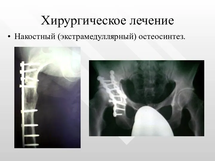 Хирургическое лечение Накостный (экстрамедуллярный) остеосинтез.