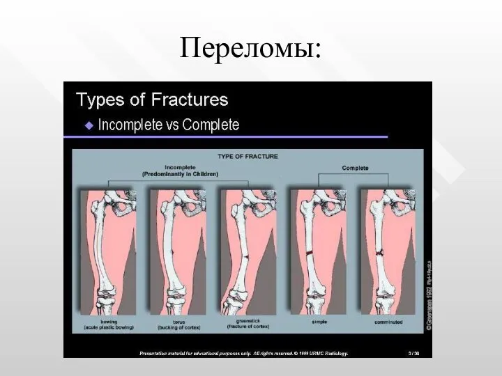Переломы: