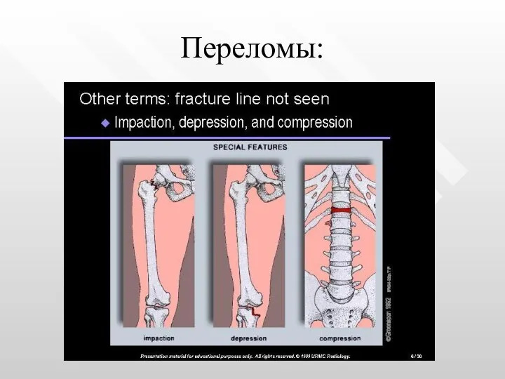 Переломы: