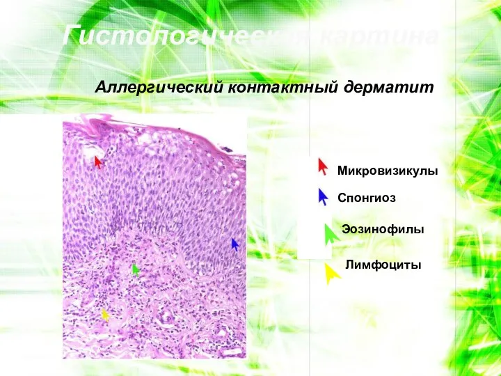 Гистологическая картина Аллергический контактный дерматит Микровизикулы Спонгиоз Эозинофилы Лимфоциты