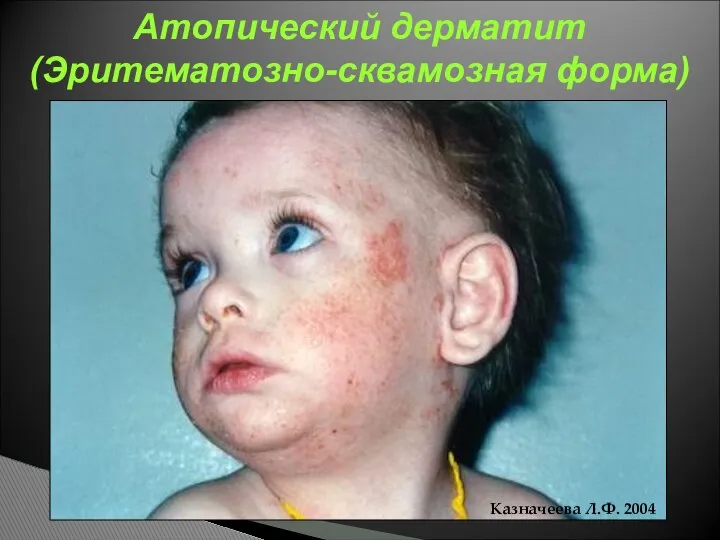 Казначеева Л.Ф. 2004 Атопический дерматит (Эритематозно-сквамозная форма)