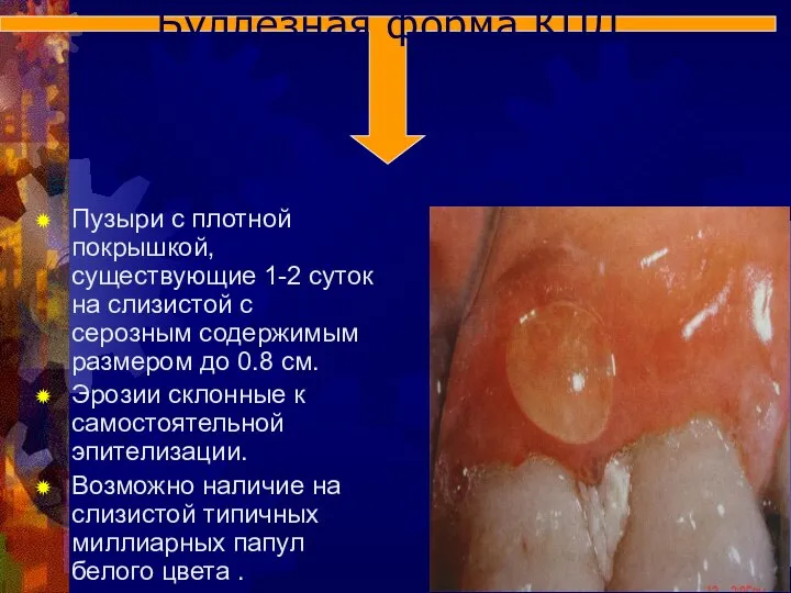 Пузыри с плотной покрышкой, существующие 1-2 суток на слизистой с серозным