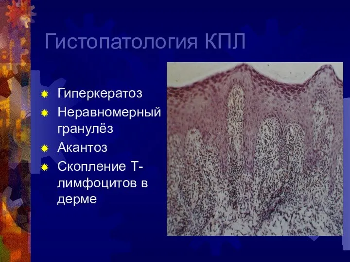 Гистопатология КПЛ Гиперкератоз Неравномерный гранулёз Акантоз Скопление Т-лимфоцитов в дерме