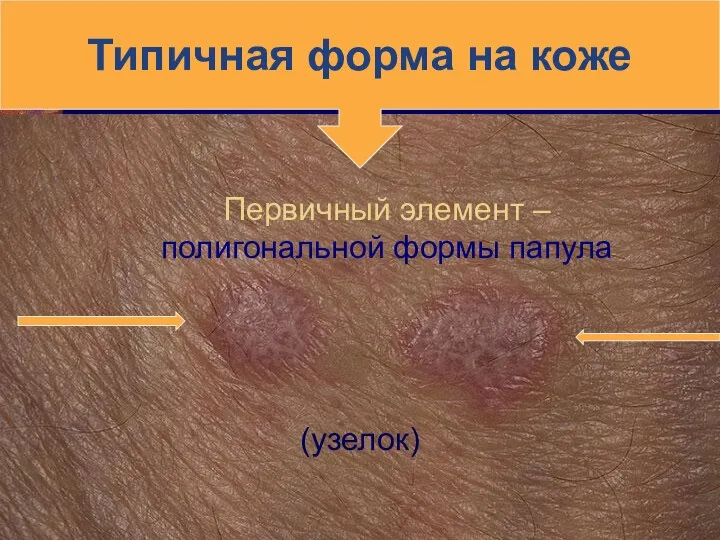 Первичный элемент – полигональной формы папула (узелок) Типичная форма на коже