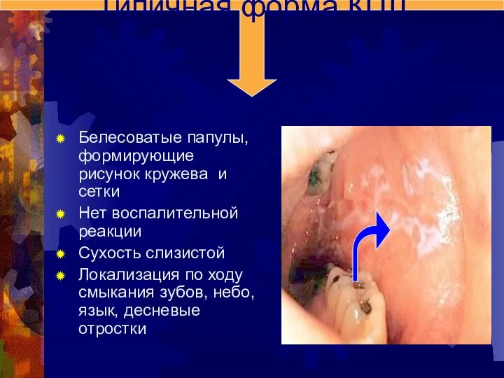 Белесоватые папулы, формирующие рисунок кружева и сетки Нет воспалительной реакции Сухость