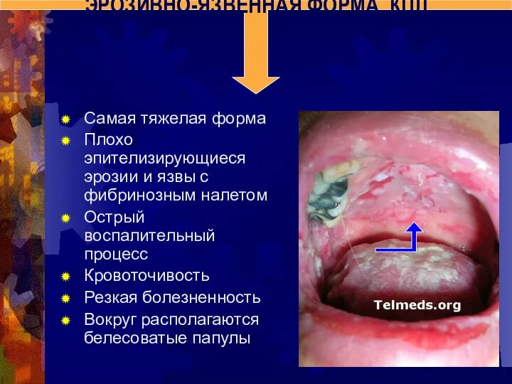 Самая тяжелая форма Плохо эпителизирующиеся эрозии и язвы с фибринозным налетом