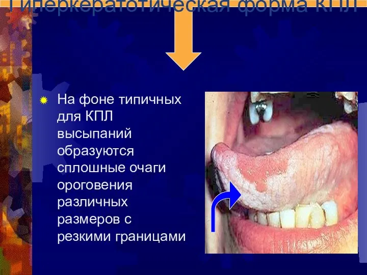 На фоне типичных для КПЛ высыпаний образуются сплошные очаги ороговения различных