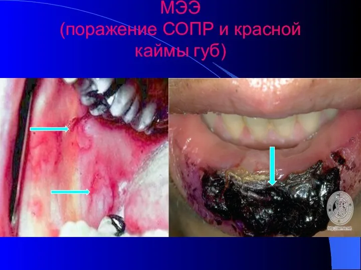 МЭЭ (поражение СОПР и красной каймы губ)