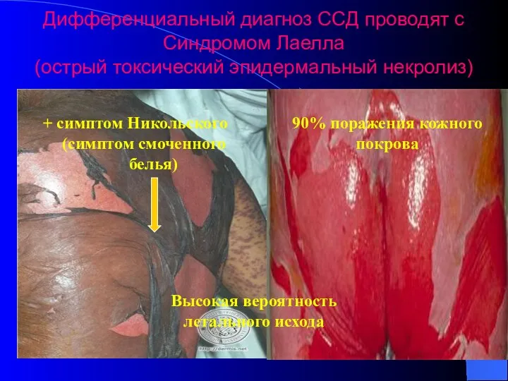 Дифференциальный диагноз ССД проводят с Синдромом Лаелла (острый токсический эпидермальный некролиз)