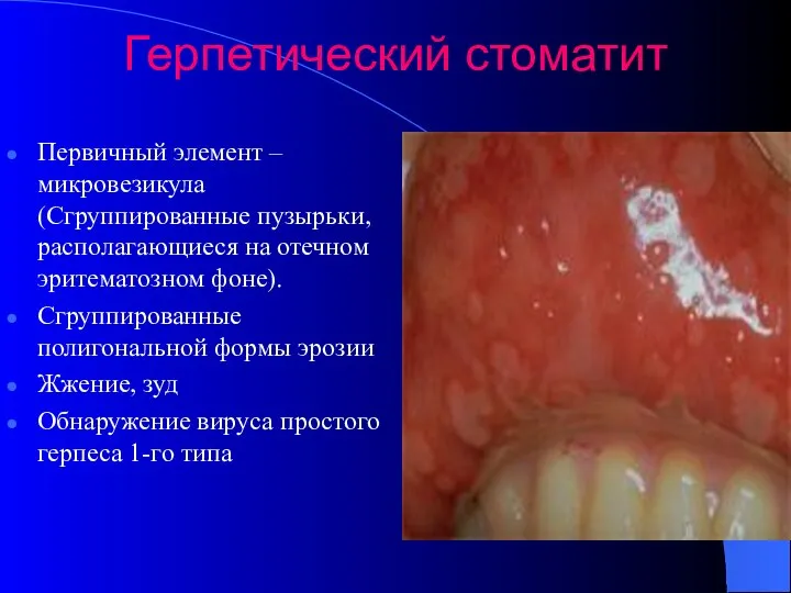 Герпетический стоматит Первичный элемент – микровезикула (Сгруппированные пузырьки, располагающиеся на отечном