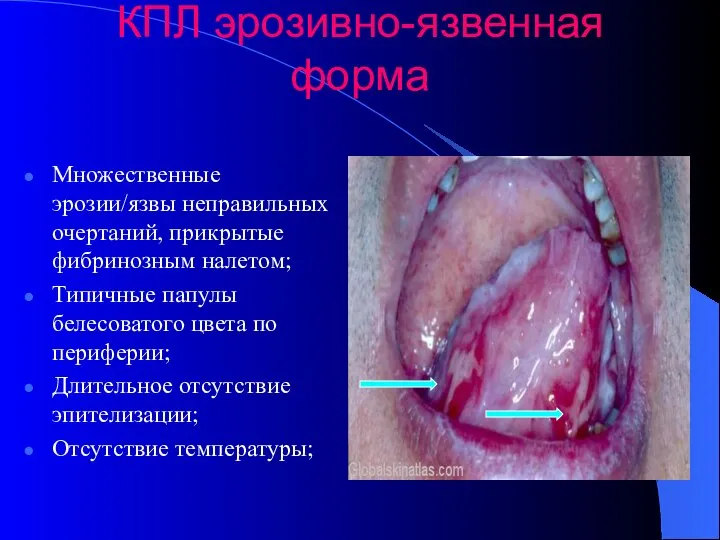 КПЛ эрозивно-язвенная форма Множественные эрозии/язвы неправильных очертаний, прикрытые фибринозным налетом; Типичные