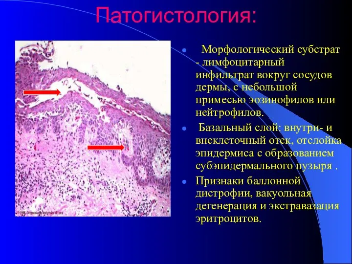 Патогистология: Морфологический субстрат - лимфоцитарный инфильтрат вокруг сосудов дермы, с небольшой