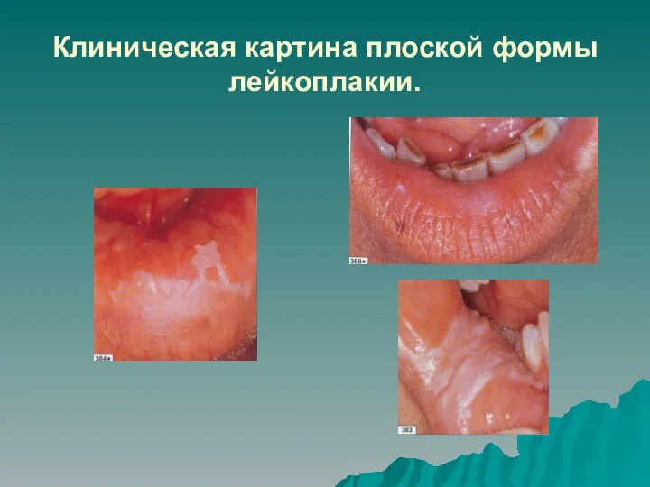 Клиническая картина плоской формы лейкоплакии.