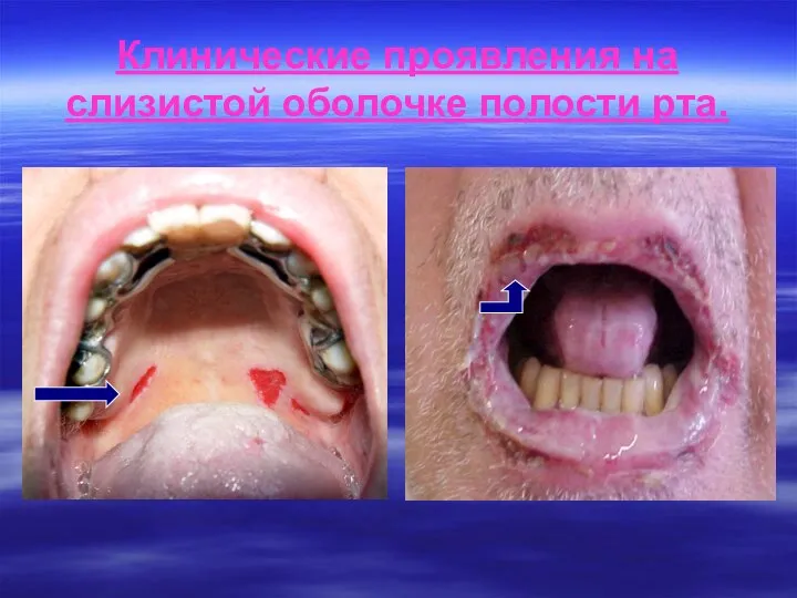 Клинические проявления на слизистой оболочке полости рта.