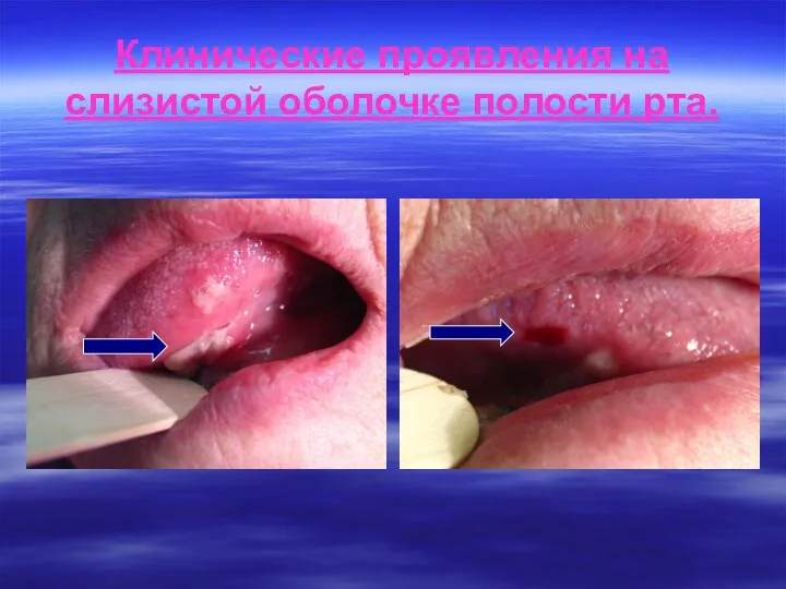 Клинические проявления на слизистой оболочке полости рта.