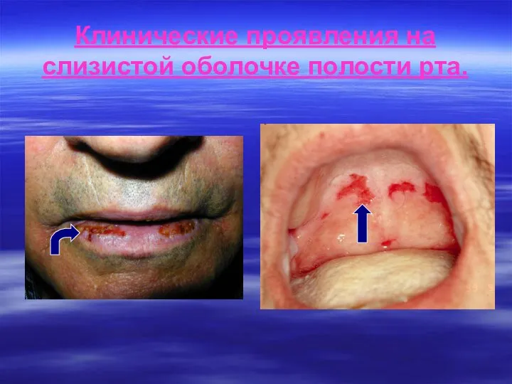 Клинические проявления на слизистой оболочке полости рта.