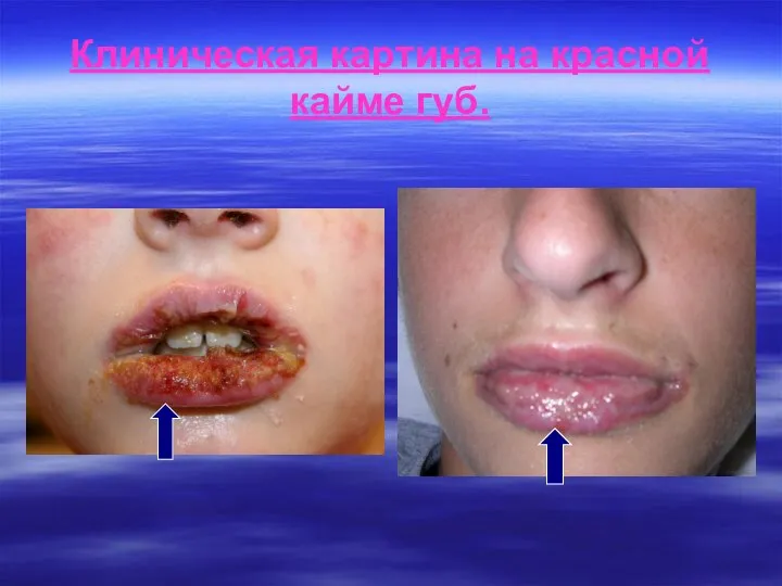 Клиническая картина на красной кайме губ.