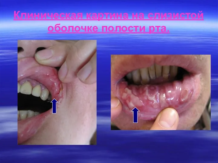 Клиническая картина на слизистой оболочке полости рта.