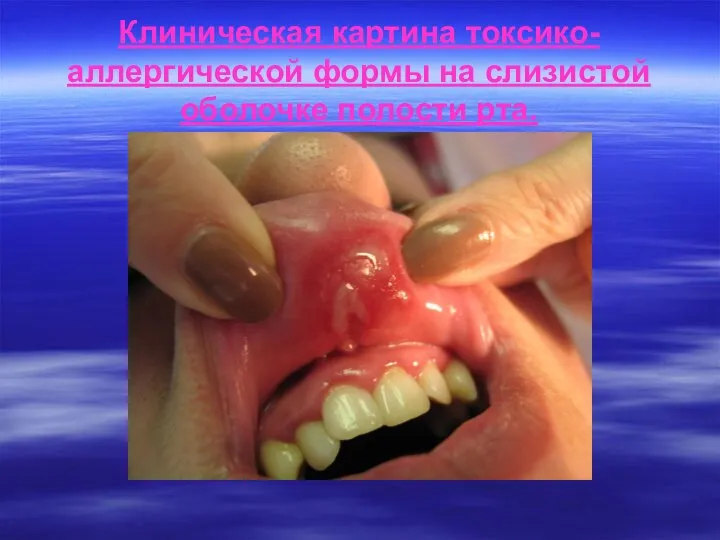 Клиническая картина токсико-аллергической формы на слизистой оболочке полости рта.