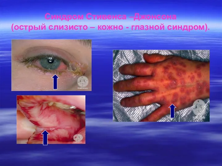 Синдром Стивенса –Джонсона (острый слизисто – кожно - глазной синдром).