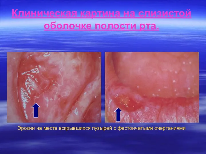 Клиническая картина на слизистой оболочке полости рта. Эрозии на месте вскрывшихся пузырей с фестончатыми очертаниями