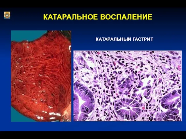 КАТАРАЛЬНОЕ ВОСПАЛЕНИЕ КАТАРАЛЬНЫЙ ГАСТРИТ