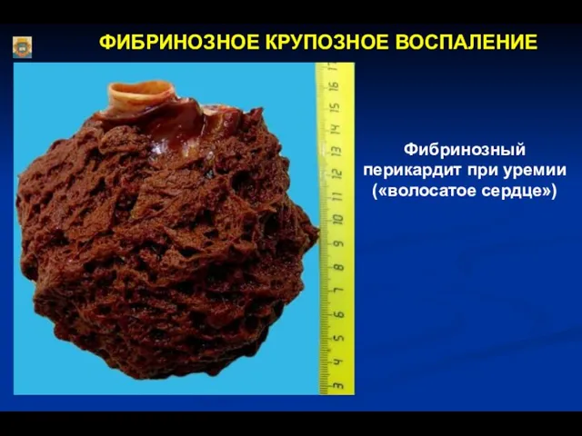 ФИБРИНОЗНОЕ КРУПОЗНОЕ ВОСПАЛЕНИЕ Фибринозный перикардит при уремии («волосатое сердце»)