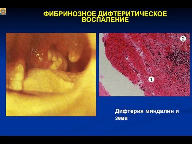 ФИБРИНОЗНОЕ ДИФТЕРИТИЧЕСКОЕ ВОСПАЛЕНИЕ Дифтерия миндалин и зева