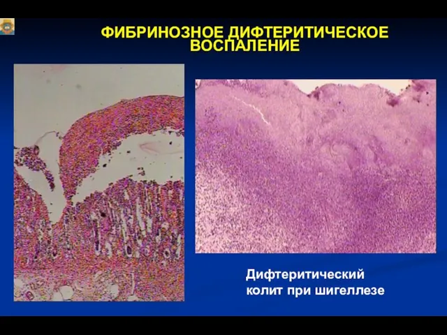 ФИБРИНОЗНОЕ ДИФТЕРИТИЧЕСКОЕ ВОСПАЛЕНИЕ Дифтеритический колит при шигеллезе