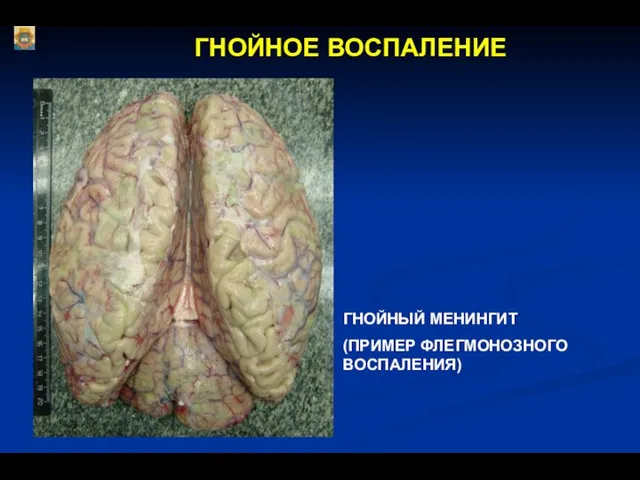 ГНОЙНОЕ ВОСПАЛЕНИЕ ГНОЙНЫЙ МЕНИНГИТ (ПРИМЕР ФЛЕГМОНОЗНОГО ВОСПАЛЕНИЯ)